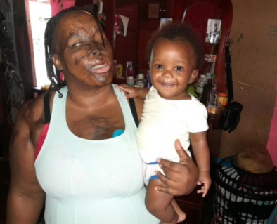 Help Charmaine after her ex-husband set her on fire